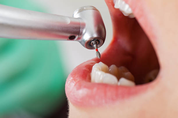 Urgent Tooth Repair in SC